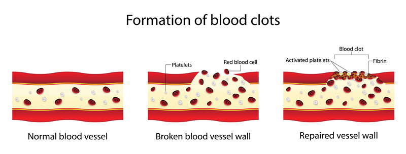 Graphic of how blood clots form in veins | Vein Centre in Tennessee