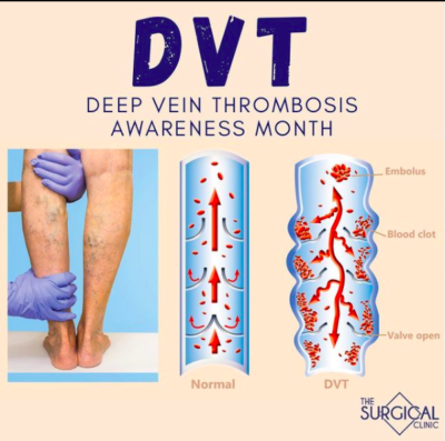 what is dvt