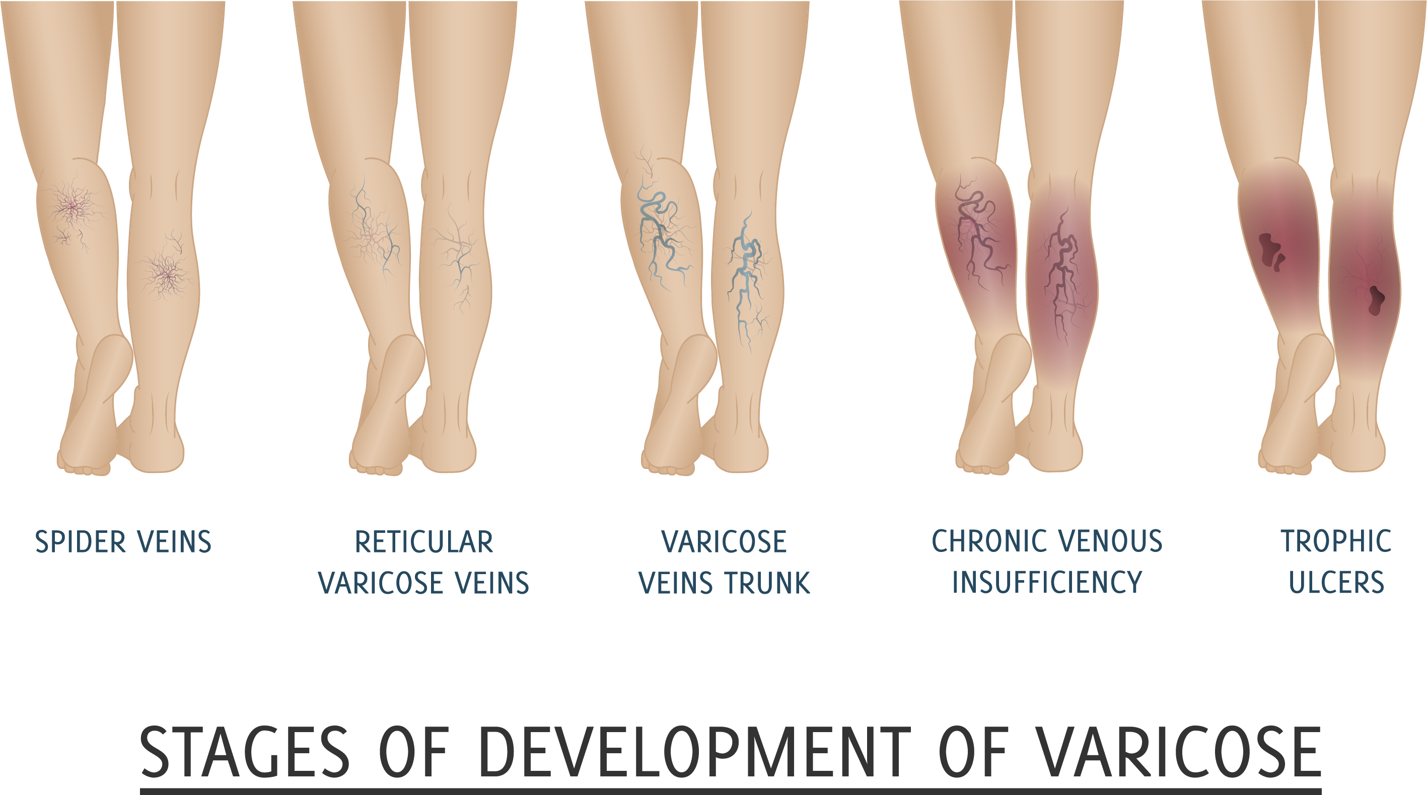 a case study of venous leg ulceration