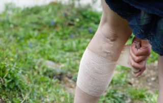 Painful leg ulcer under bandage