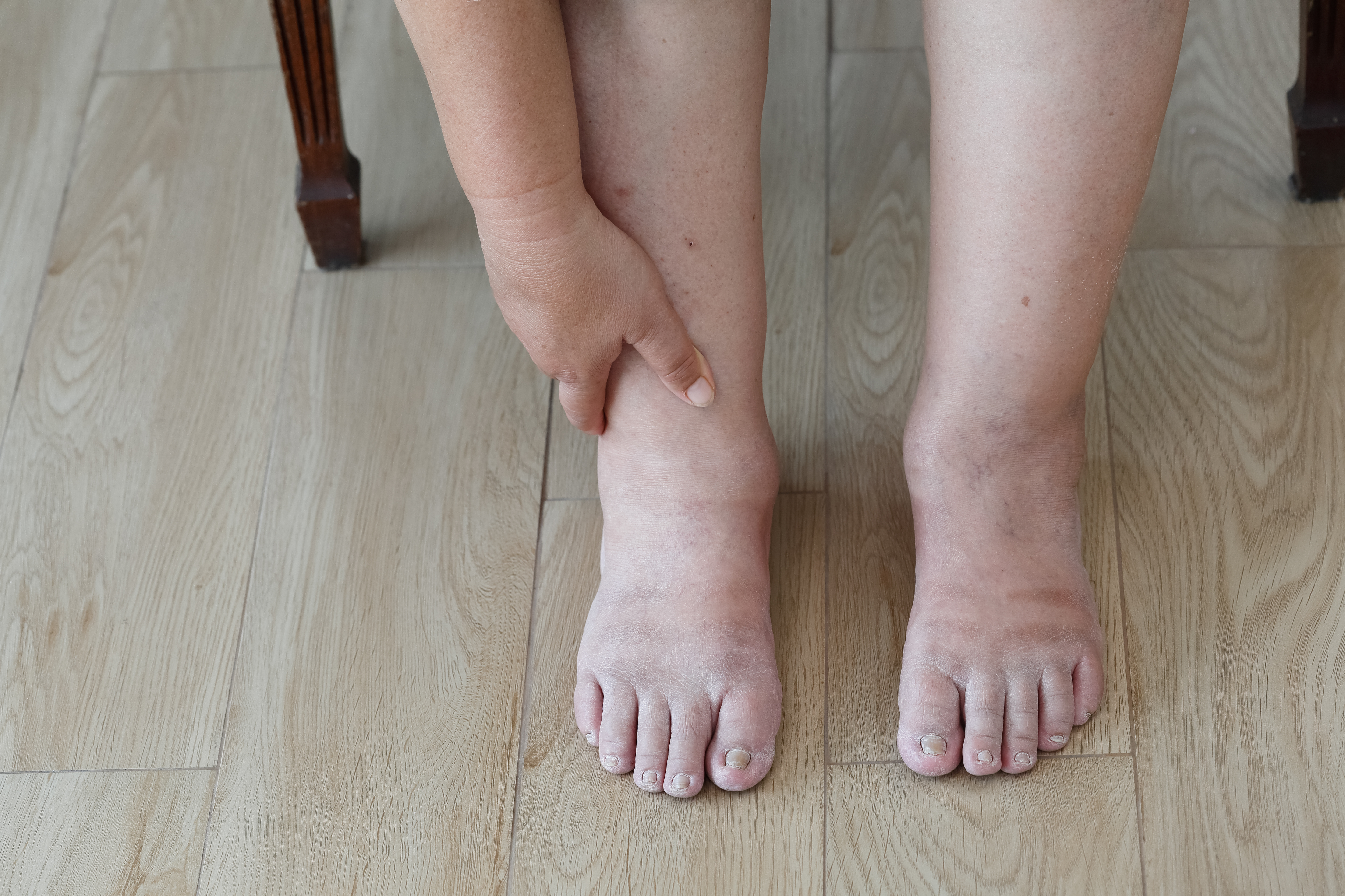 Treating Venous Ulcers relieves painful sore and heaviness in the legs
