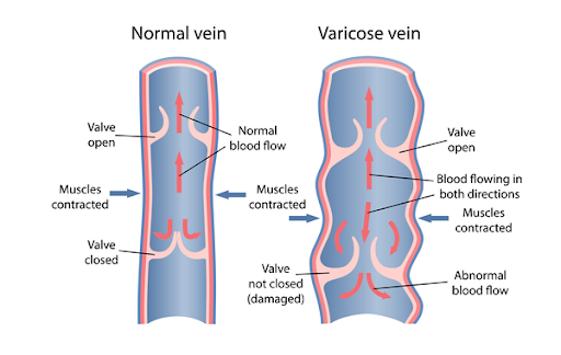 Diagram of damaged vein showing varicose vein