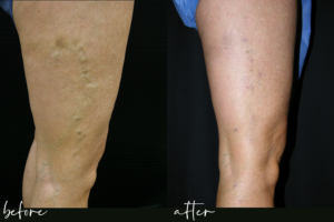 varicose vein treatment in nashville at the vein centre phlebectomy before and after