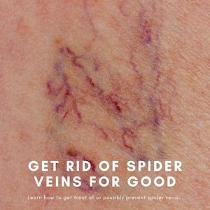 get rid of spider veins for good with spider vein treatment in middle Tennessee