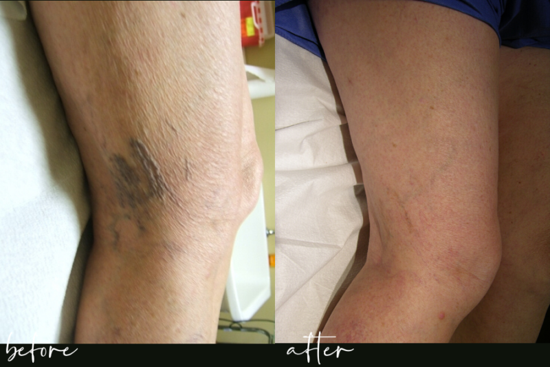 sclero brentwood tn sclerotherapy in franklin brentwood belle meade and nashville varicose vein treatment in nashville, images before vein treatment EVLT & Phlebectomies vein surgery varicose vein treatment