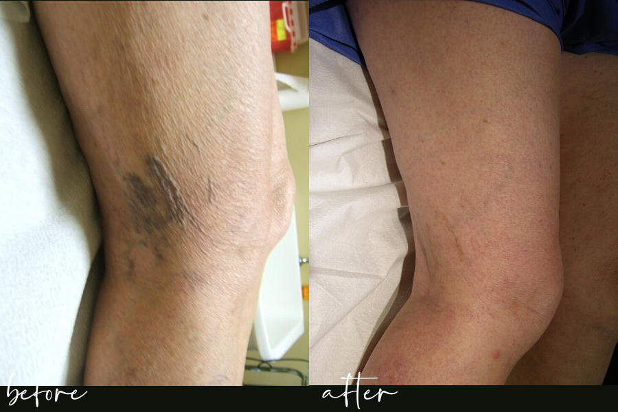 sclerotherapy before and after in nashville sclero nashville tn