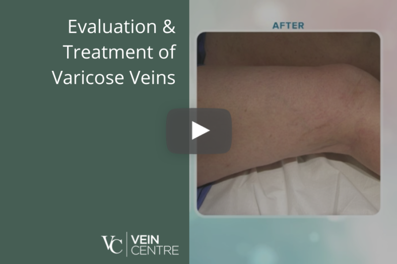 varicose veins vascular surgeon Dr. Billy J. Kim