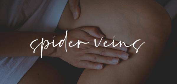 spider veins and treatment in tennessee