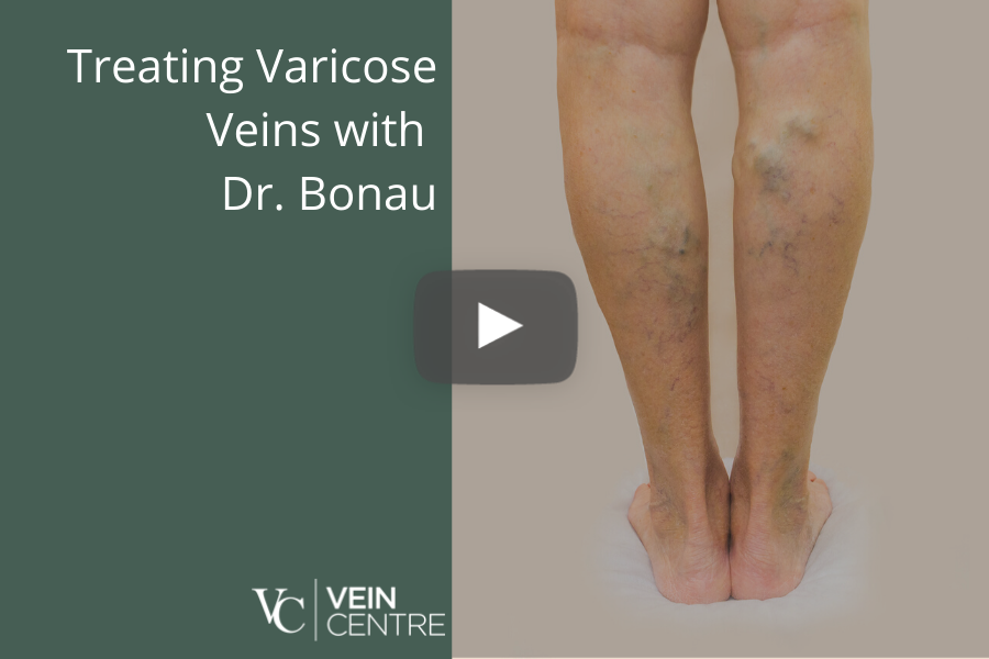 treating varicose veins with dr roger bonau