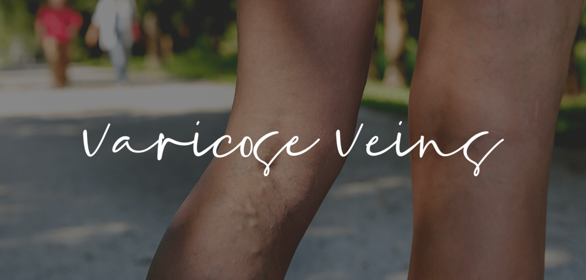 Varicose Veins & Treatment Nashville, TN