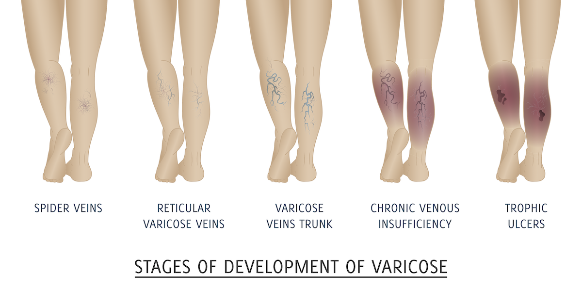 https://veinreliever.com/wp-content/uploads/2020/04/stages-of-vein-health.png