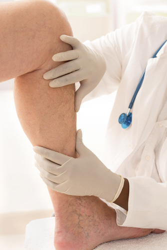 when to see a doctor for varicose veins in tennessee