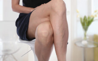varicose veins are clues to a deeper problem | Vein Centre in Tennessee