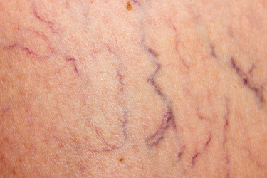 Close up photo of spider veins from the Nashville Vein Center that need spider vein treatment.