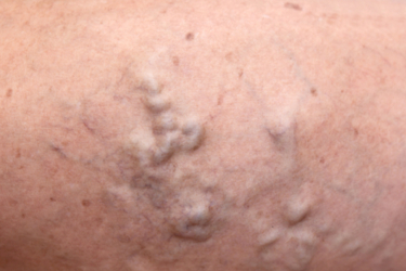 Photo of varicose veins from The Nashville Vein Center that need varicose vein treatment.