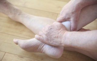feet and hands with varicose veins needing laser treatment