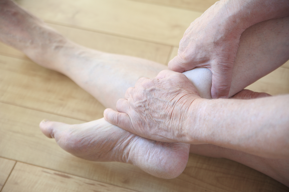 feet and hands with varicose veins needing laser treatment