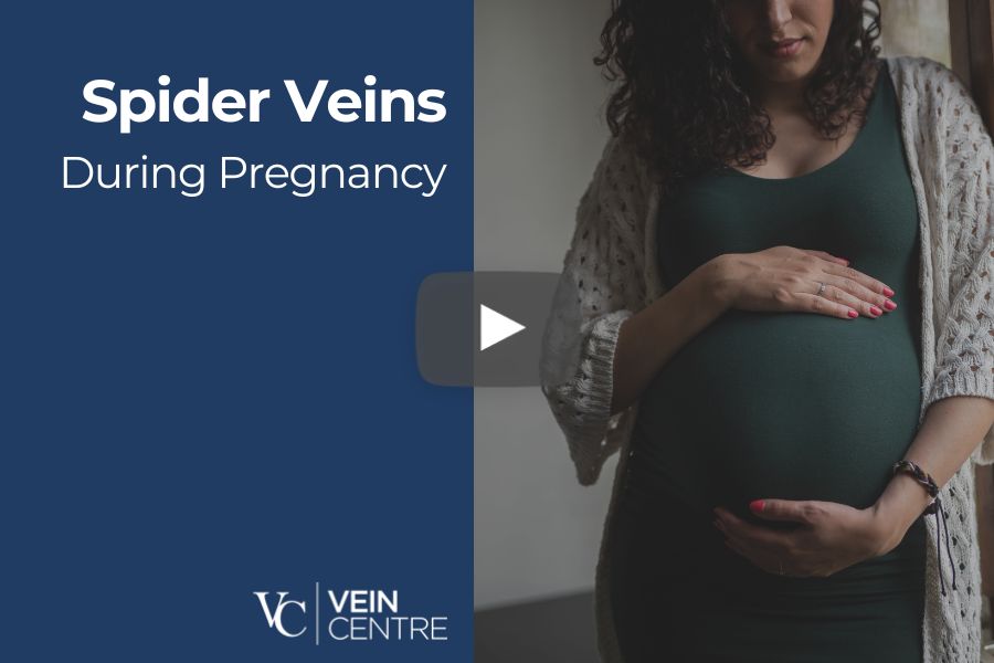 Varicose Veins During Pregnancy sclerotherapy sclero nashville