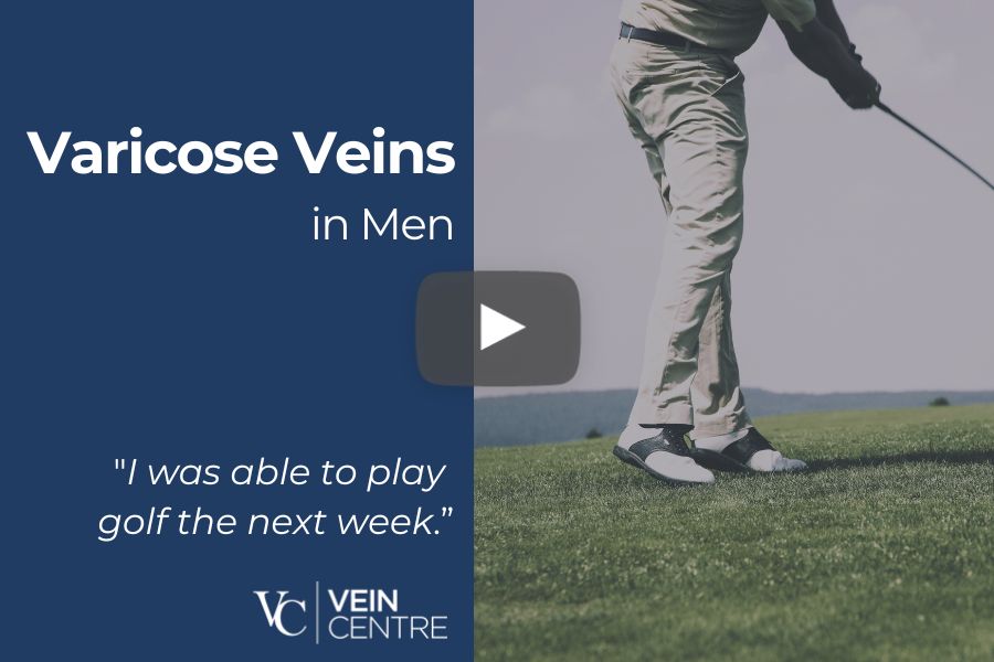 Varicose Veins In Men, varicose vein treatment nashville