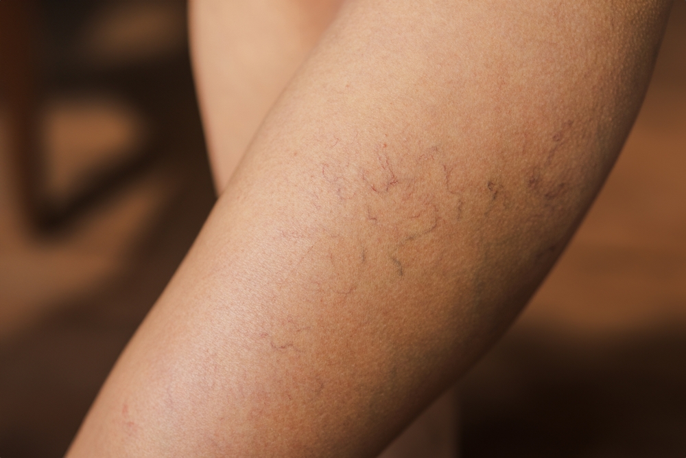 Spider veins on a person's thigh.