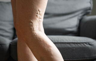 varicose veins on legs
