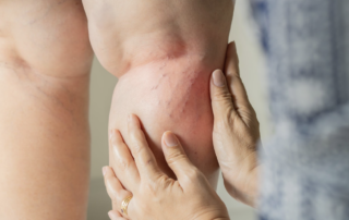 Woman with varicose veins