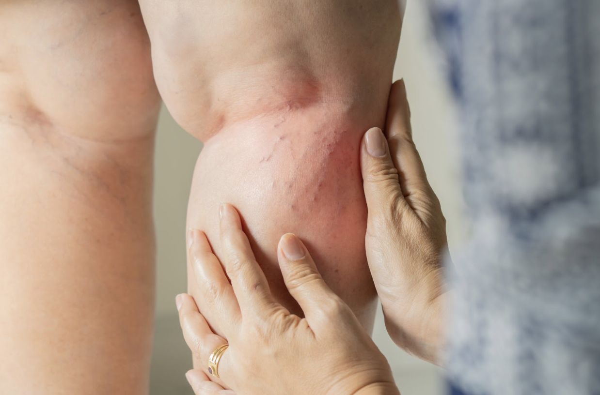 Woman with varicose veins