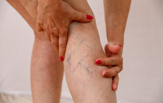 Dark blue veins on a woman's leg