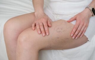 Woman sitting on a bed touching spider veins on her upper thigh